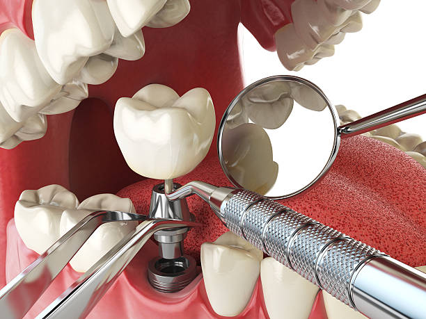 Best Emergency Dental Extractions in Lufkin, TX